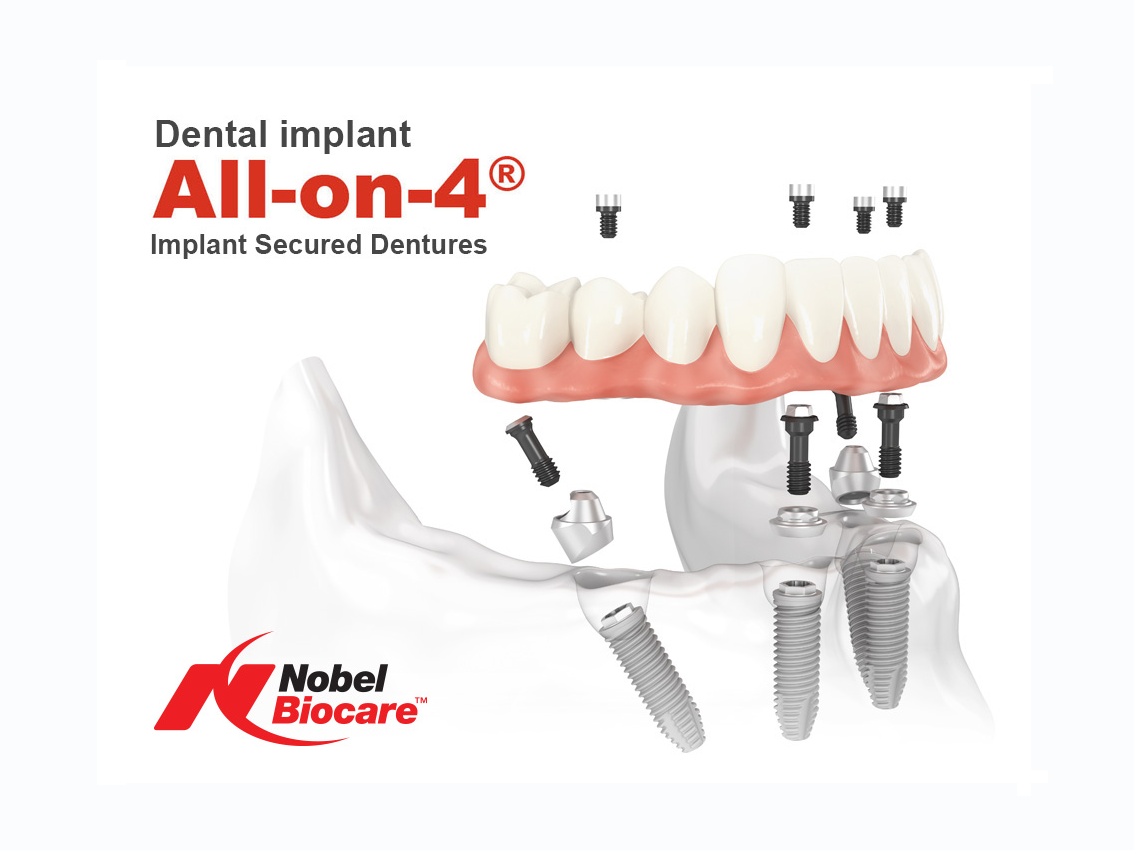 Implant secured Dentures