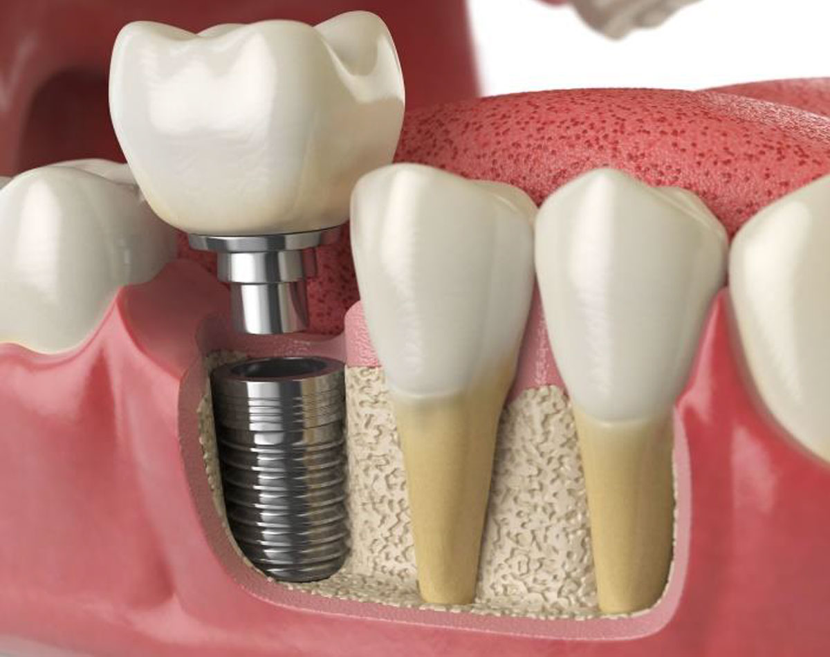 https://cuspdentals.com/wp-content/uploads/2022/08/Dental-Implants.jpg