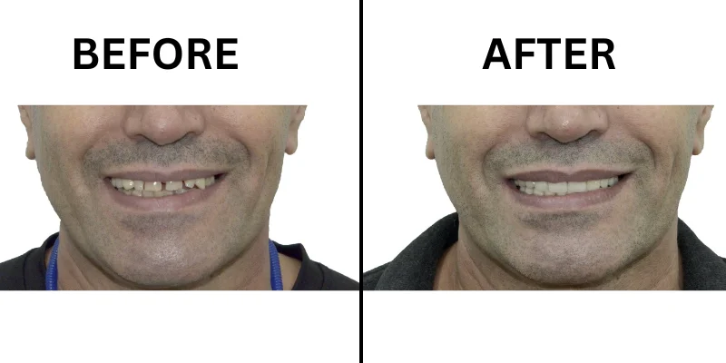 Before and After Full Mouth Restoration