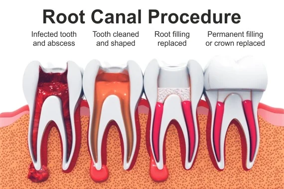 Procedure Of Root Canal Treatment in Gurgaon