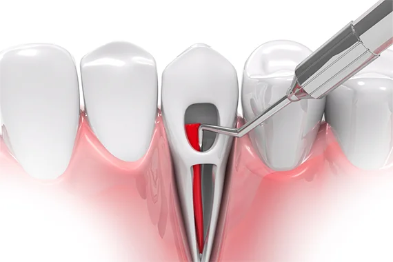 when is Root Canal Treatment Required