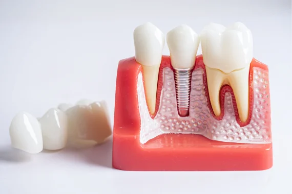 Symptoms and Causes Requiring Dental Implants