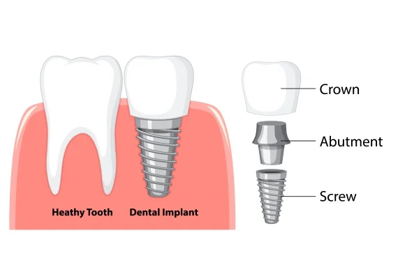 What Are Dental Implant