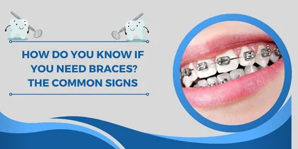 How Do You Know If You Need Braces? Common Signs