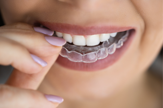 Benefits of Clear aligner