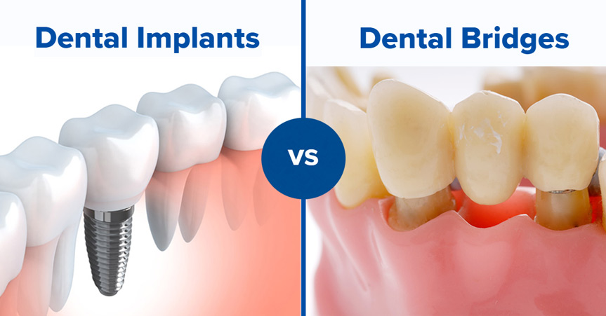 Dental Implants vs Bridges: Best Tooth Replacement Option in Gurgaon