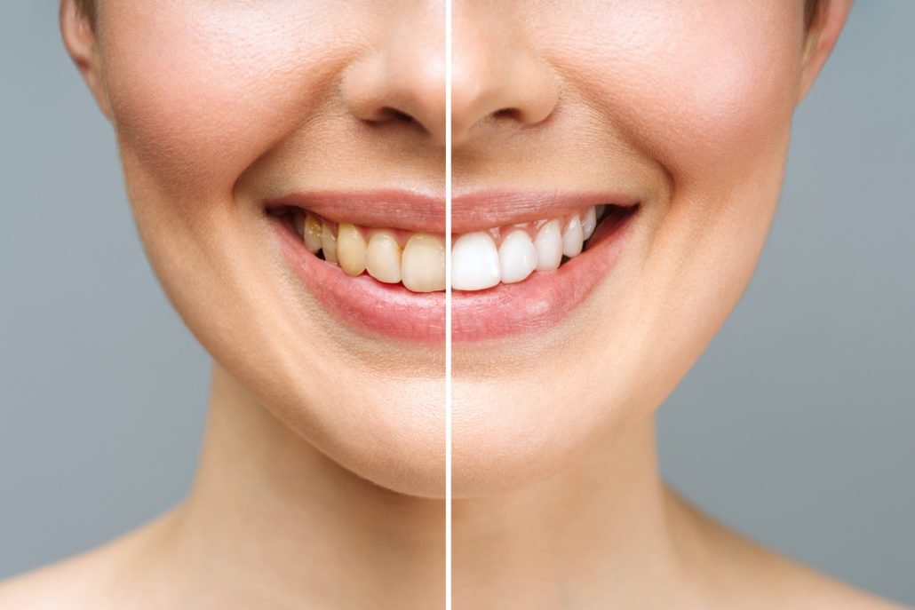 https://cuspdentals.com/wp-content/uploads/2026/08/What-Changes-After-a-Smile-Makeover.jpg